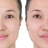 [Pack] Tratamiento facial anti-acné