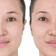 Pack Soin visage anti-acné